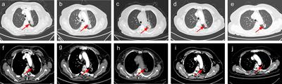 Aumolertinib Effectively Reduces Clinical Symptoms of an EGFR L858R-Mutant Non-Small Cell Lung Cancer Case Coupled With Osimertinib-Induced Cardiotoxicity: Case Report and Review